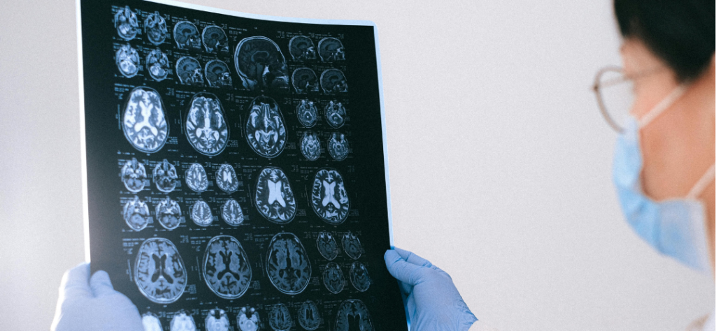 Especialista analisando exames de neuroimagem para verificar o estágio de evolução do Alzheimer em um paciente.