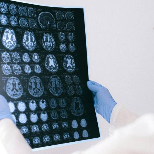 Alzheimer: Anvisa aprova 1º tratamento capaz de retardar o avanço 26 Especialista analisando exames de neuroimagem para verificar o estágio de evolução do Alzheimer em um paciente.