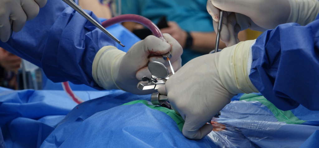 Polilaminina: a descoberta brasileira que pode mudar para sempre o futuro das lesões na medula 7 Equipe médica realizando cirurgia de coluna onde é utilizada a Polilaminina para auxiliar na regeneração.