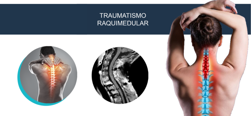 Polilaminina: a descoberta brasileira que pode mudar para sempre o futuro das lesões na medula 2 Infográfico sobre traumatismo raquimedular detalhando as áreas onde a Polilaminina atua na recuperação nervosa.